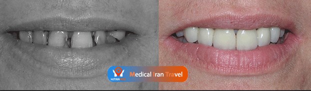 Dentures Before / After Results in Iran