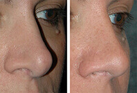 Drooping of the Tip of the Nose revision rhinoplasty