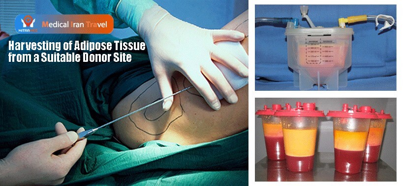 1. Harvesting of Adipose Tissue from a Suitable Donor Site