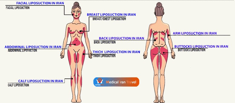 Appropriate Places in the Body for a Liposuction in Iran