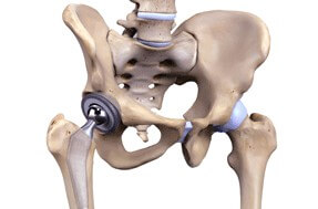 Hip Replacement Surgery