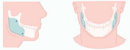 Jaw augmentation implants