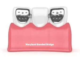 Maryland Bonded Bridge in Iran