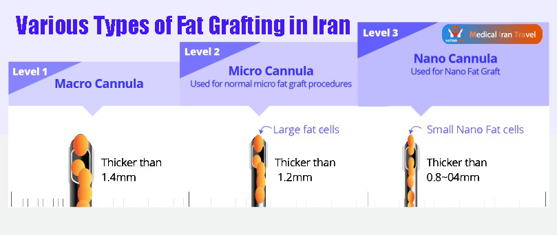 Micro Fat Transfer in Iran