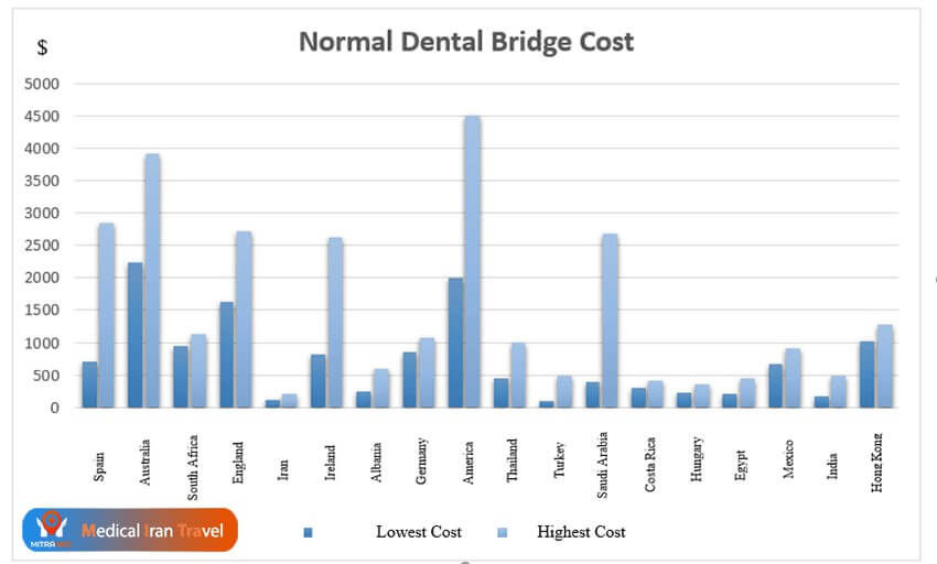The Costs of Having a Dental Bridges