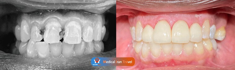 Dental crowns before after results