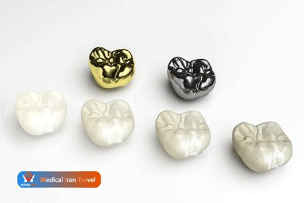 Metal or tooth color dental crowns in Iran