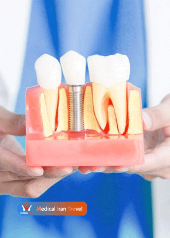 Dental Implants in Iran