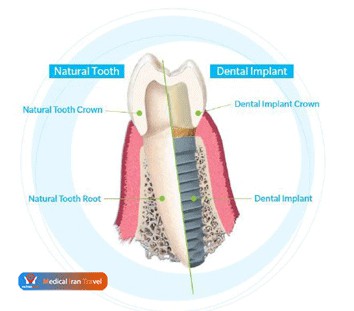 Dental implants structure