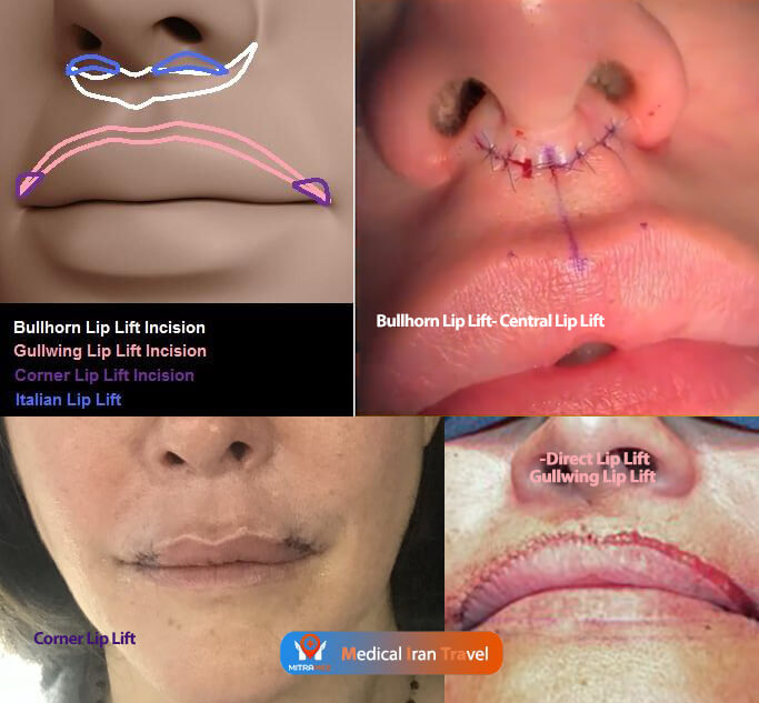 lip lift incision techniques methods