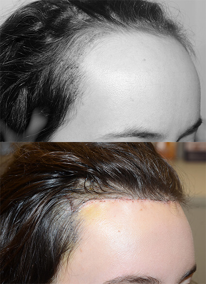 hairline lowering results