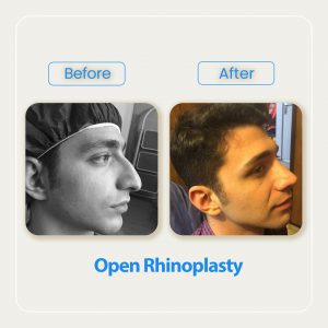 rhinoplasty before after result