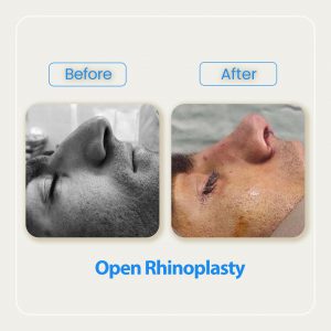 rhinoplasty before after photo