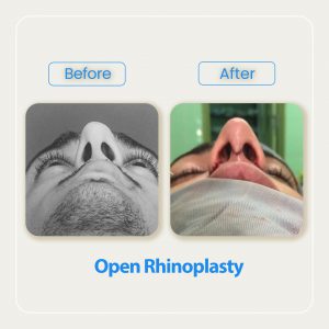 rhinoplasty before after result