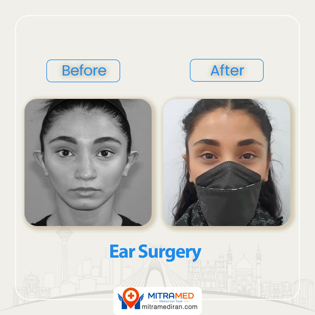 Ear surgery before after1