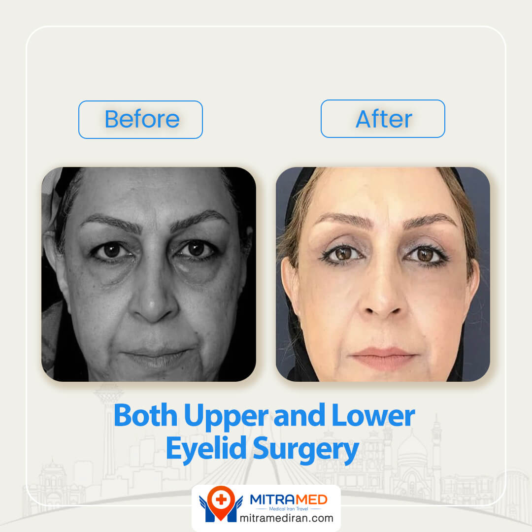 both lower and upper eyelid surgery before after-1