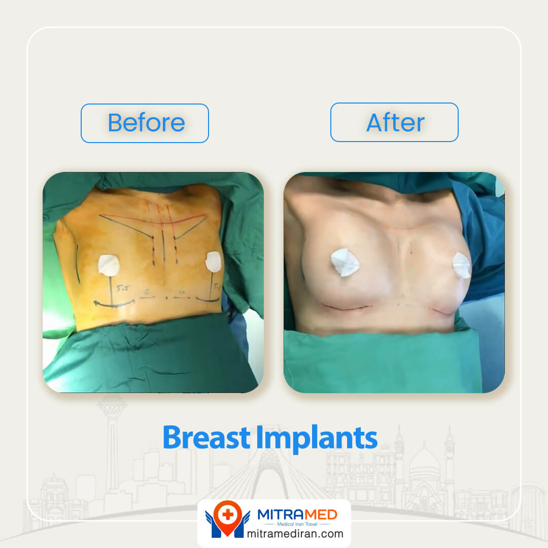 breast implants before after-1