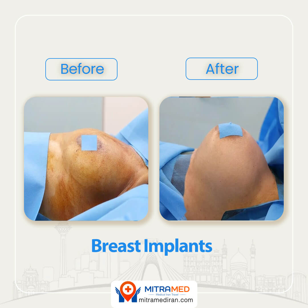 breast implants before after-2