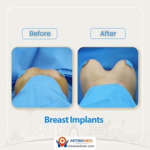 breast implants before after-3