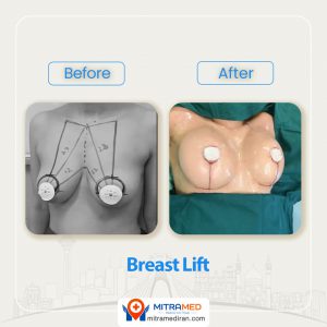 breast lift before after-1