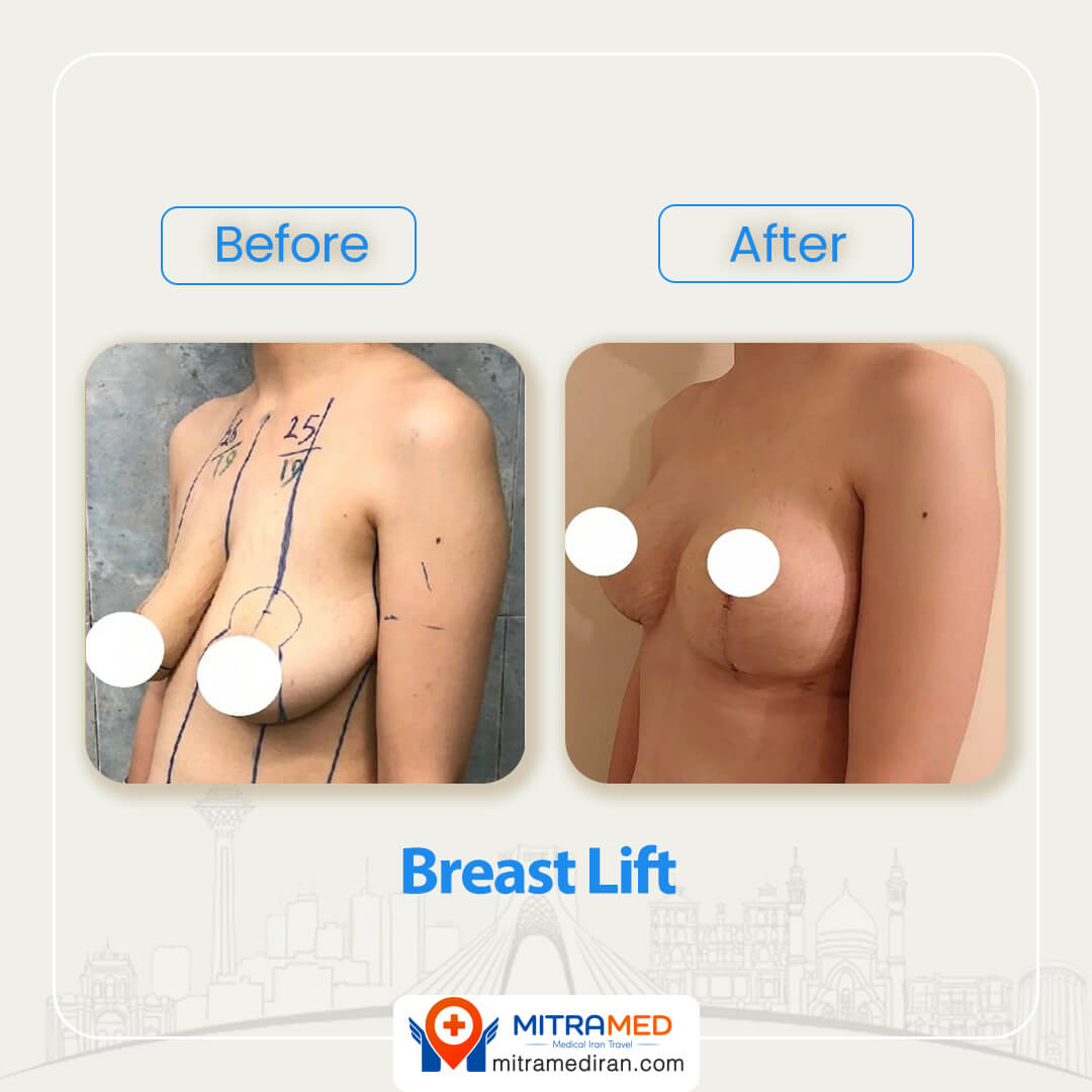 Breast Augmentation Using Fat Injection or Implants?