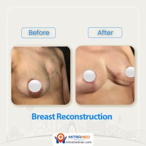breast reconstruction before after-1