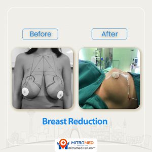 breast reduction before after-1