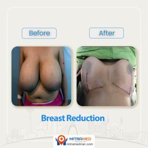 breast reduction before after-2