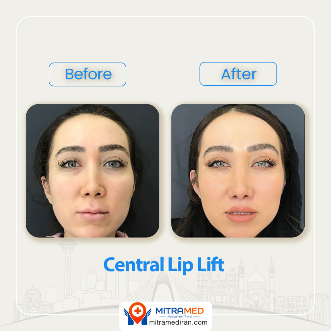 central lip lift before after-2