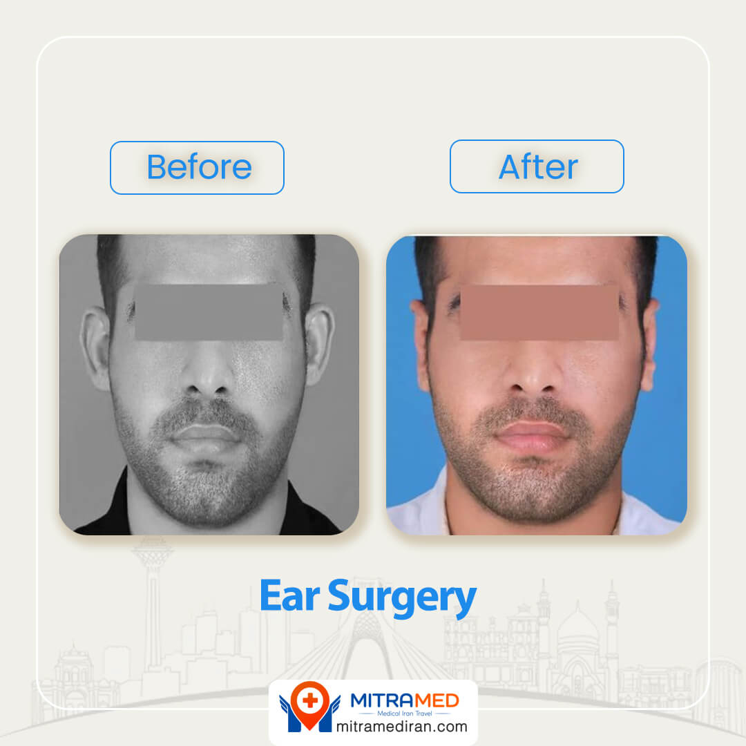 ear surgery before after-3