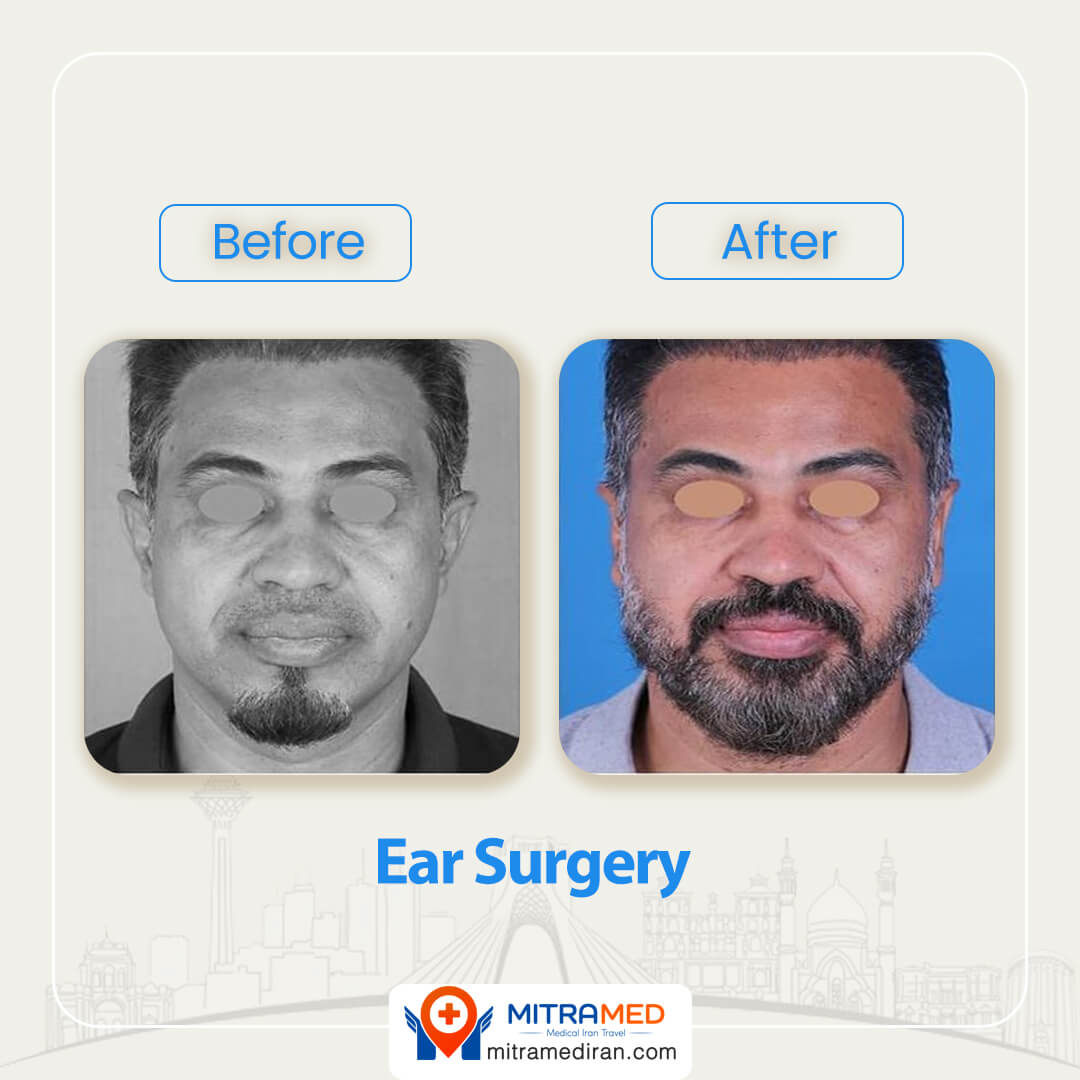 ear surgery before after-4