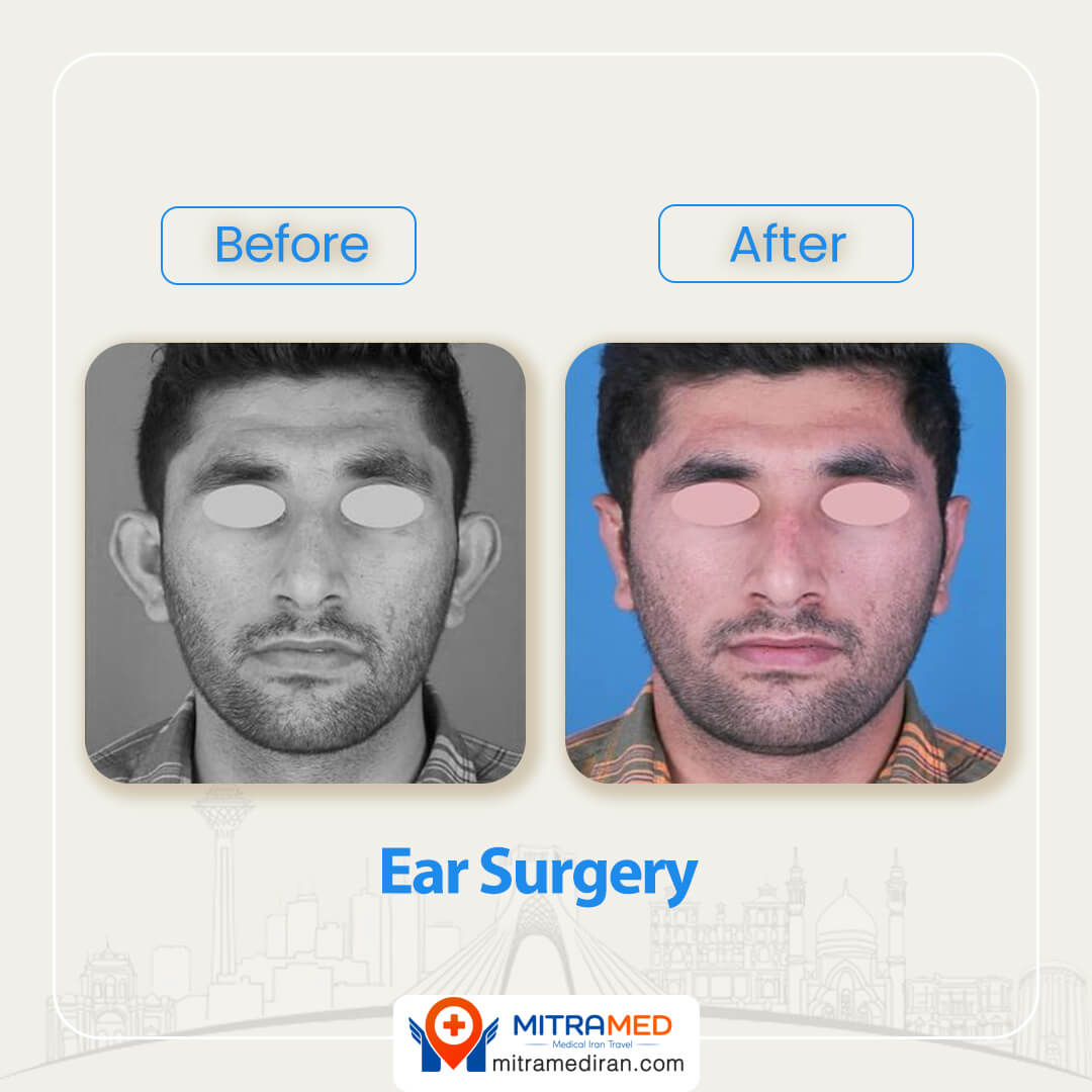 ear surgery before after-5