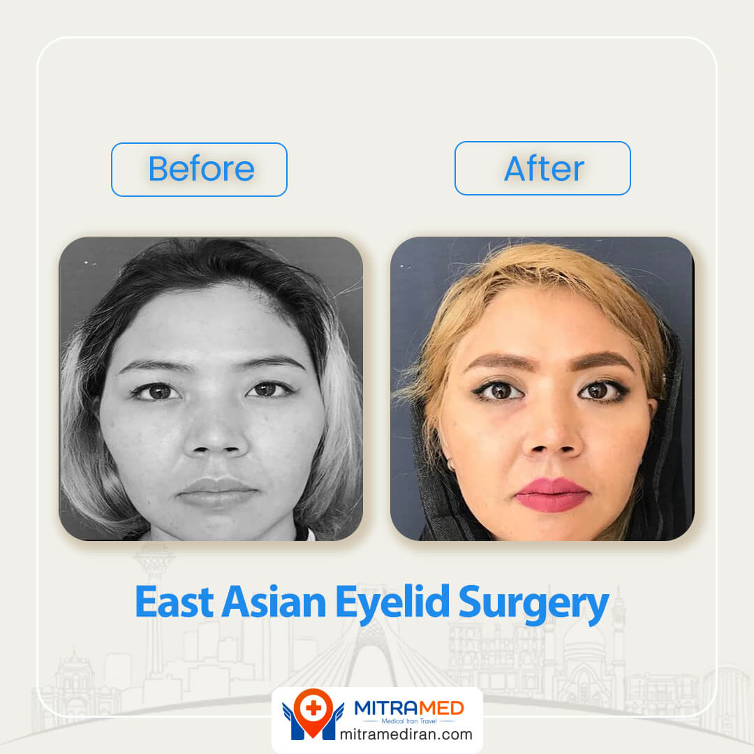 east asian eyelid surgery before after-1