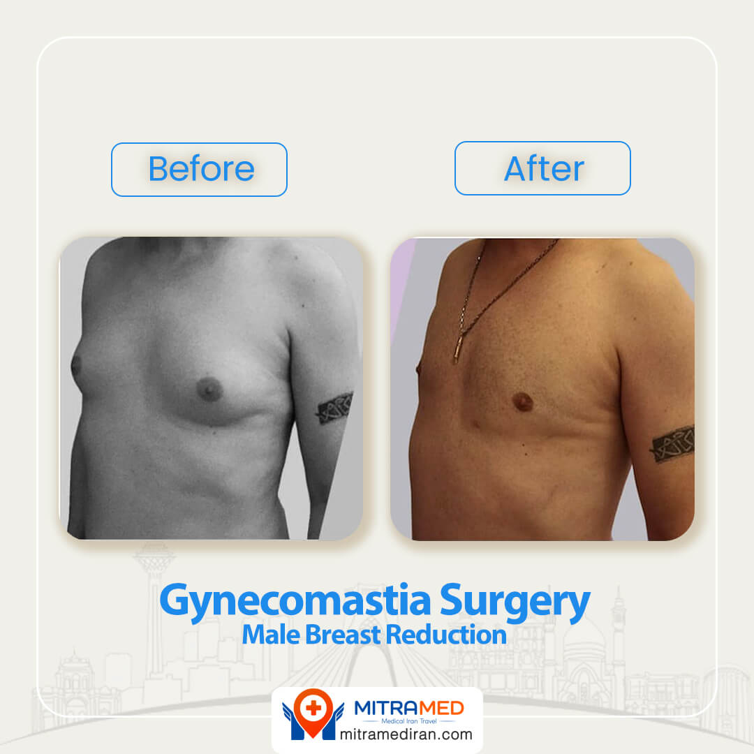 gynecomastia surgery before after-1