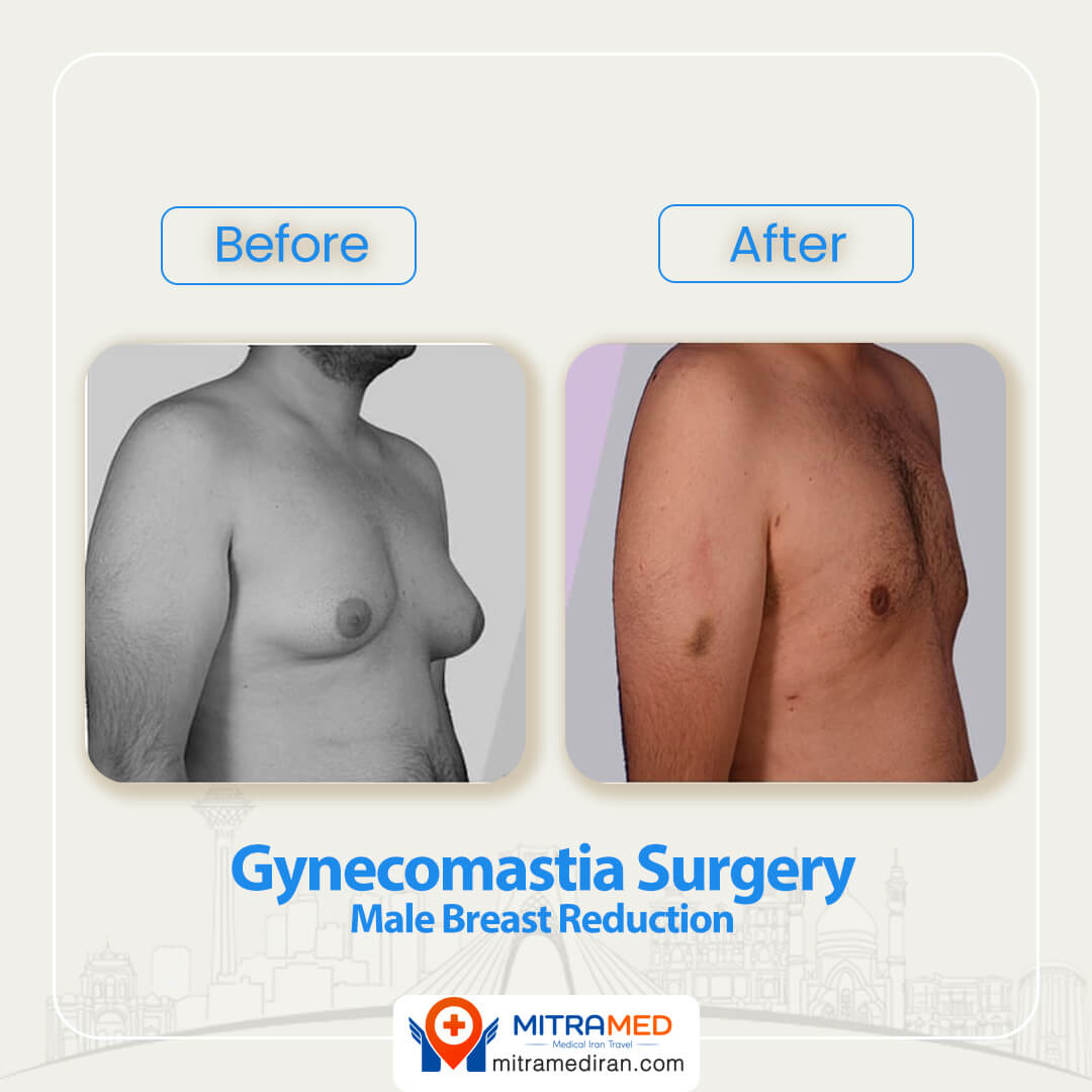 gynecomastia surgery before after-2