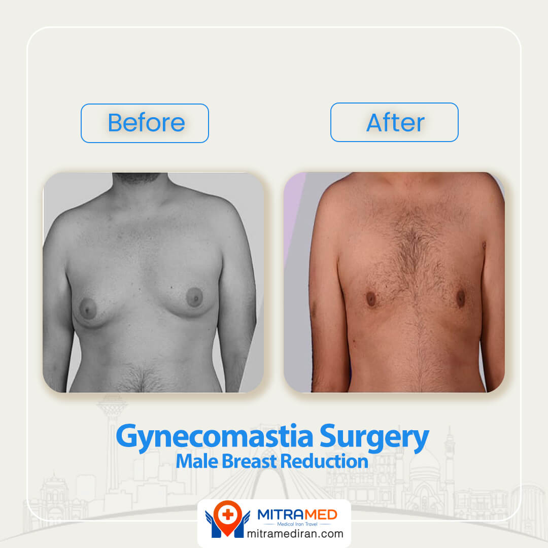 gynecomastia surgery before after-3