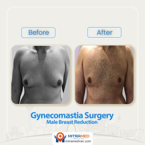 gynecomastia surgery before after-4