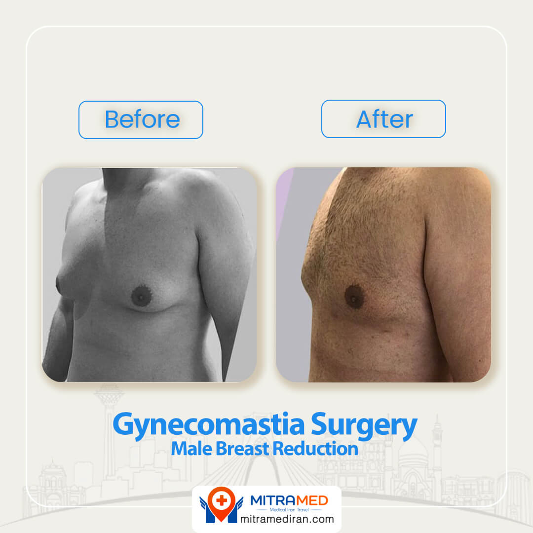 gynecomastia surgery before after-5