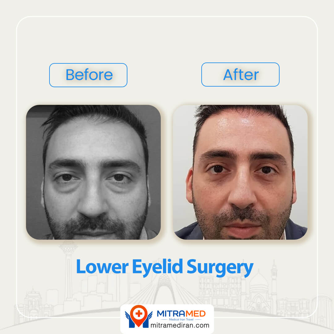 lower eyelid surgery before after-1