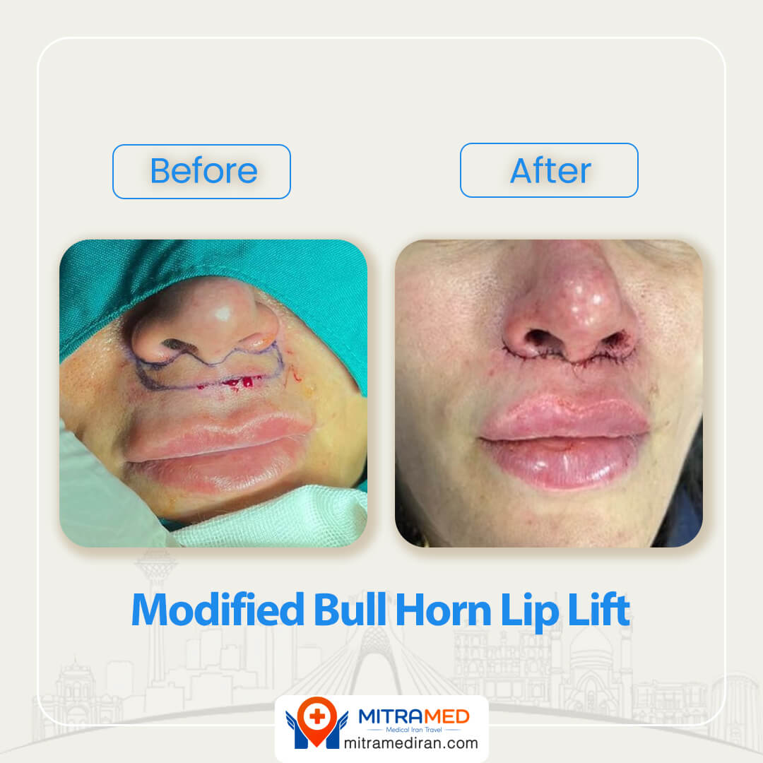 modified bull horn lip lift before after