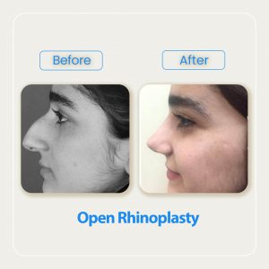 open rhinoplasty before after-1