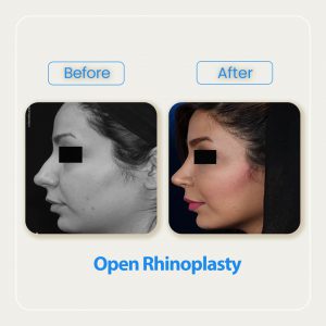 open rhinoplasty before after-4