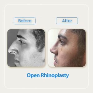 open rhinoplasty before after-6