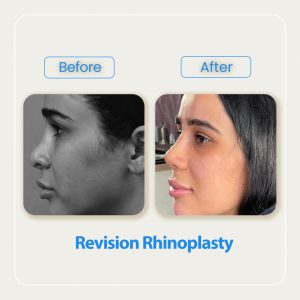 revision rhinoplasty before after-1