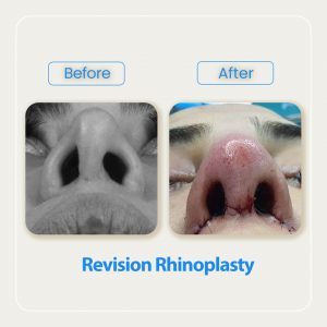 revision rhinoplasty before after-2