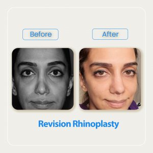 revision rhinoplasty before after-3
