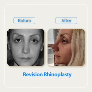 revision rhinoplasty before after-4