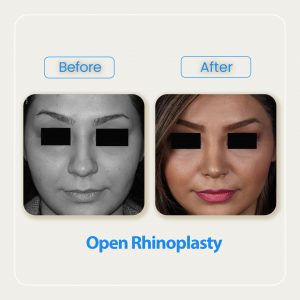 open rhinoplasty before after-9