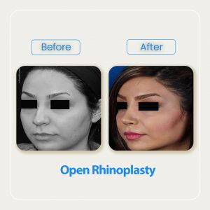 rhinoplasty before after-3