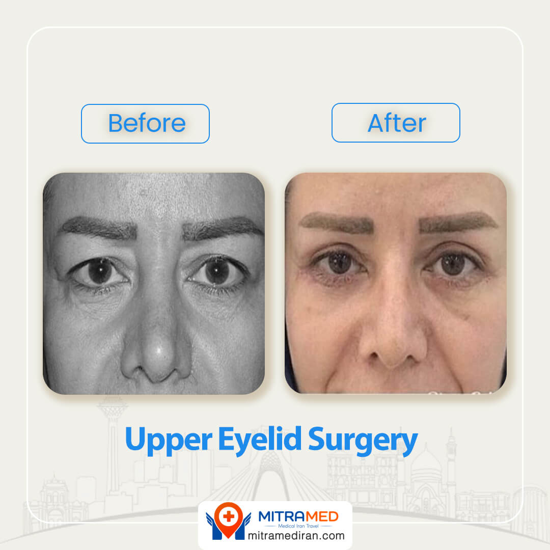 upper eyelid surgery before after-1